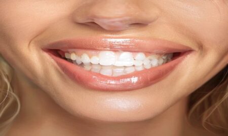 Treatments Included in a Smile Makeover