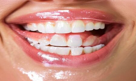 Top 6 Benefits of the Professional Teeth Whitening Top 6 Benefits of the Professional Teeth Whitening