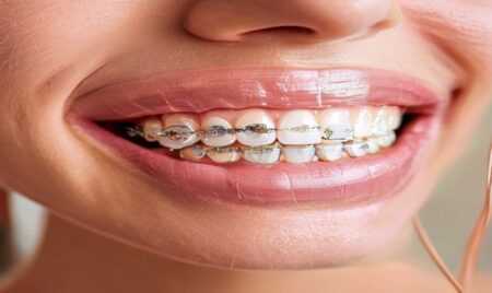 Common Techniques for Teeth Straightening