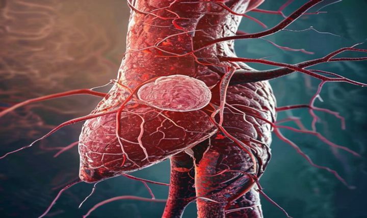 Understanding Vascular Problems